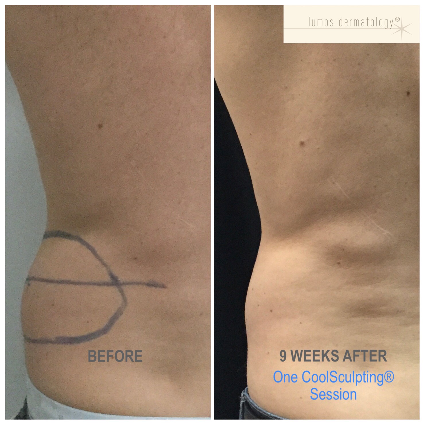 CoolSculpting left posterior flank before and after 1 treatment.JPEG