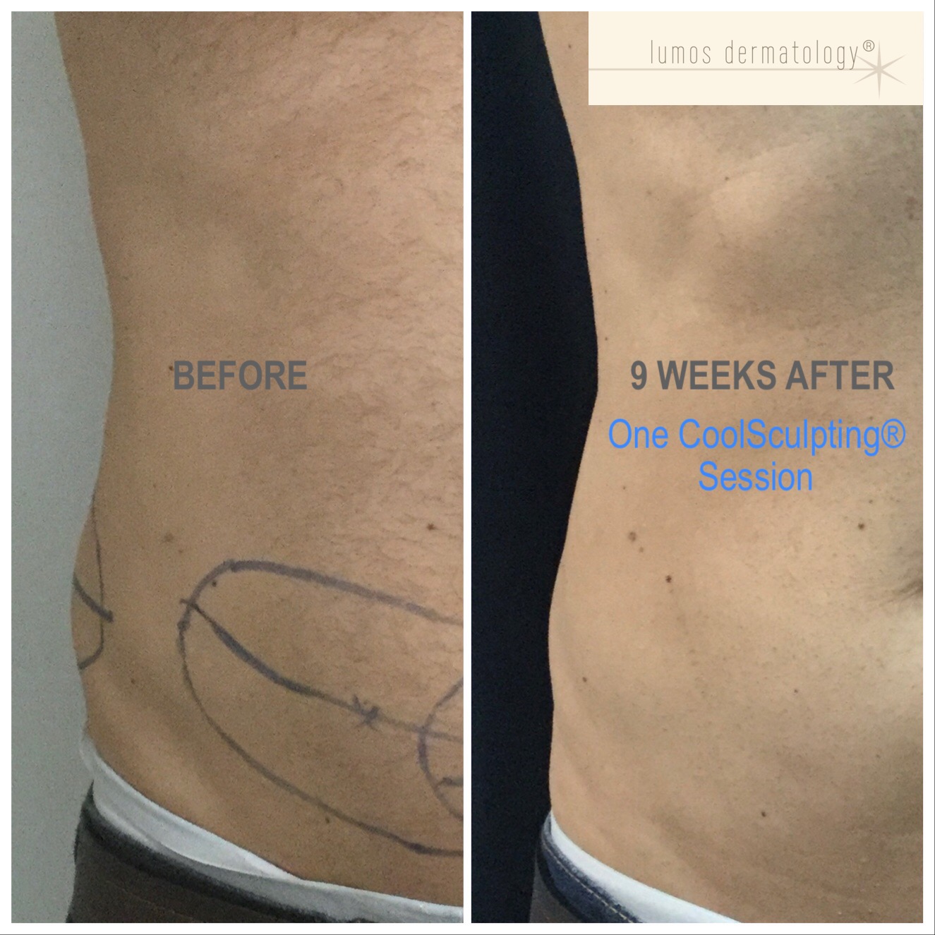 CoolSculpting right anterior flank before and after 1 treatment.JPEG