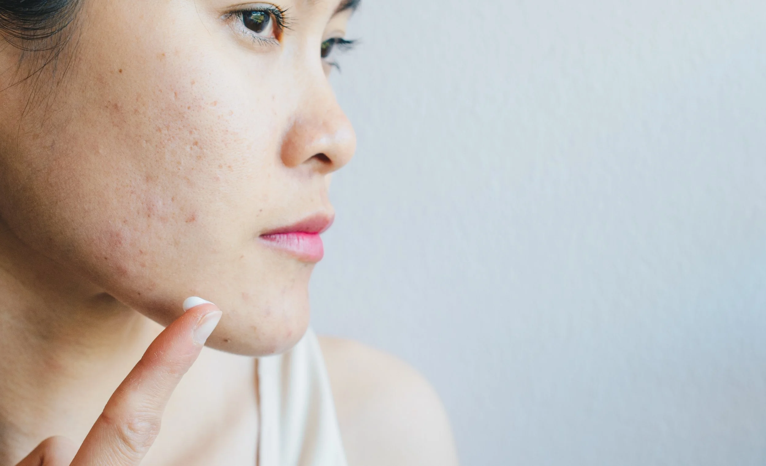 Asian woman applying acne cream on her face.