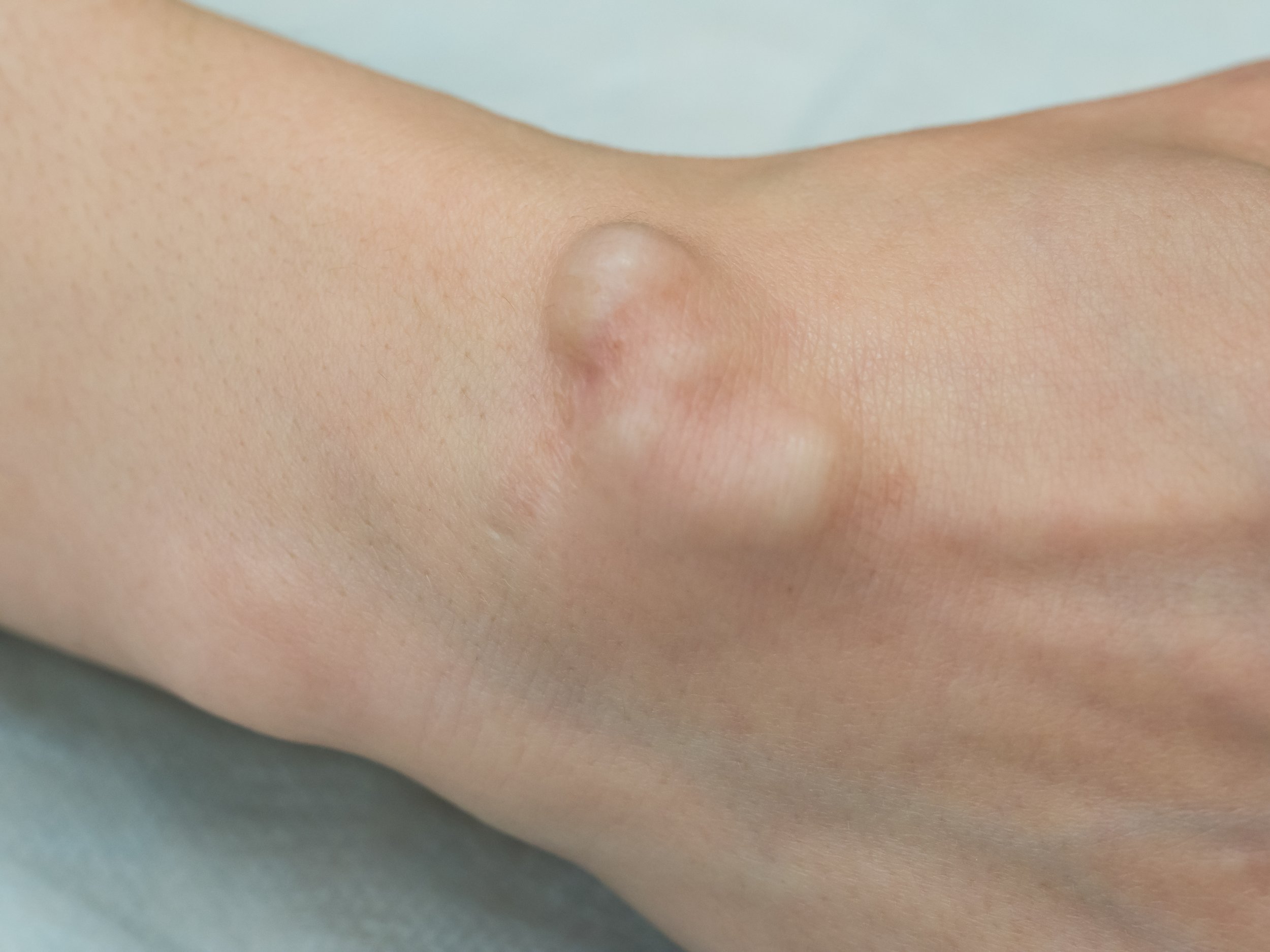 Big cyst (hygroma), fluid filled lump associated with a joint
