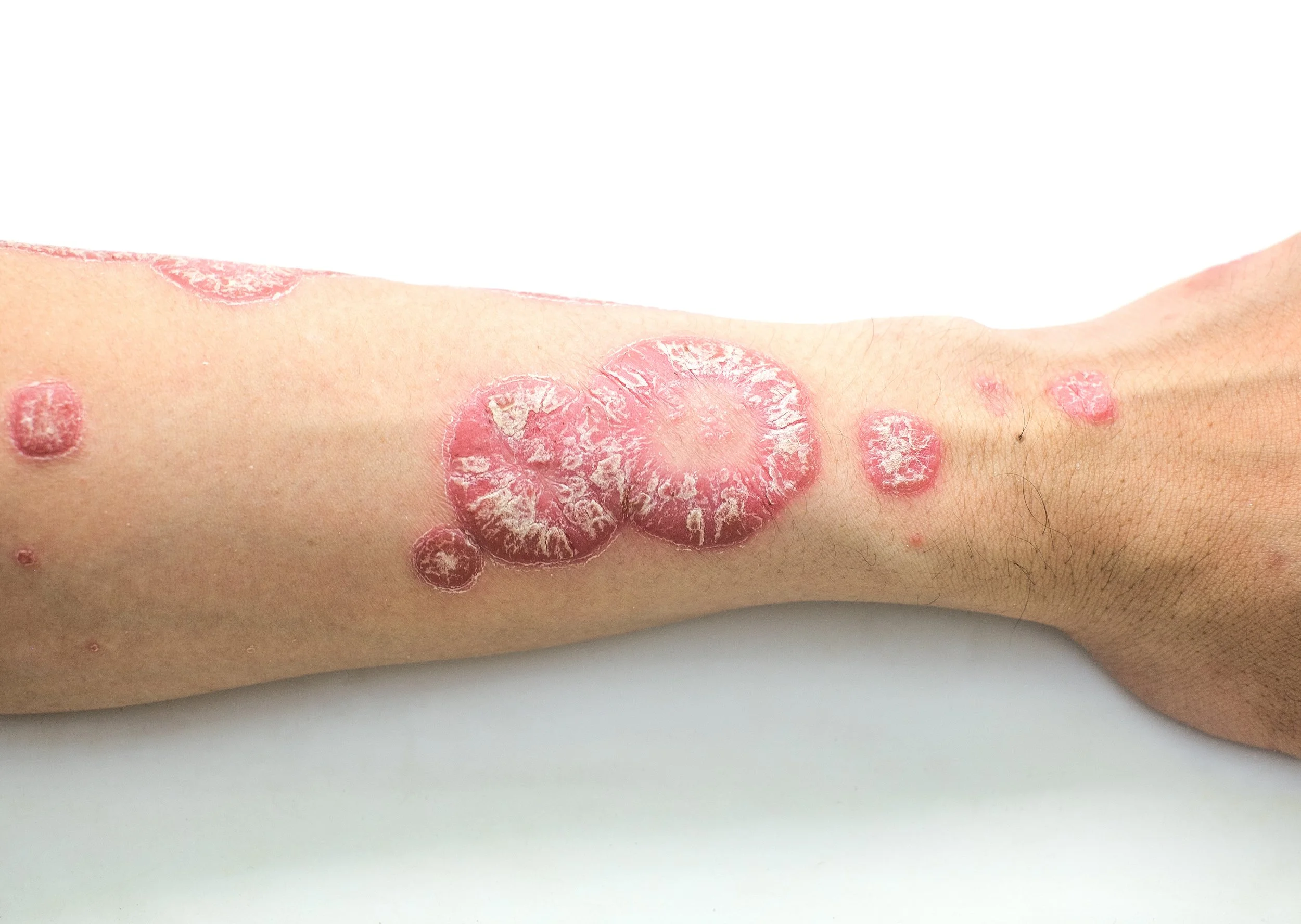 Psoriasis