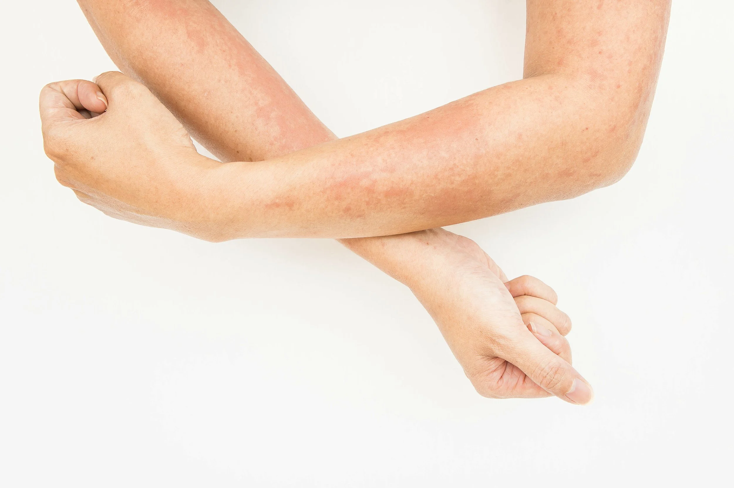 Skin rashes, allergies contact dermatitis ,allergic to chemicals