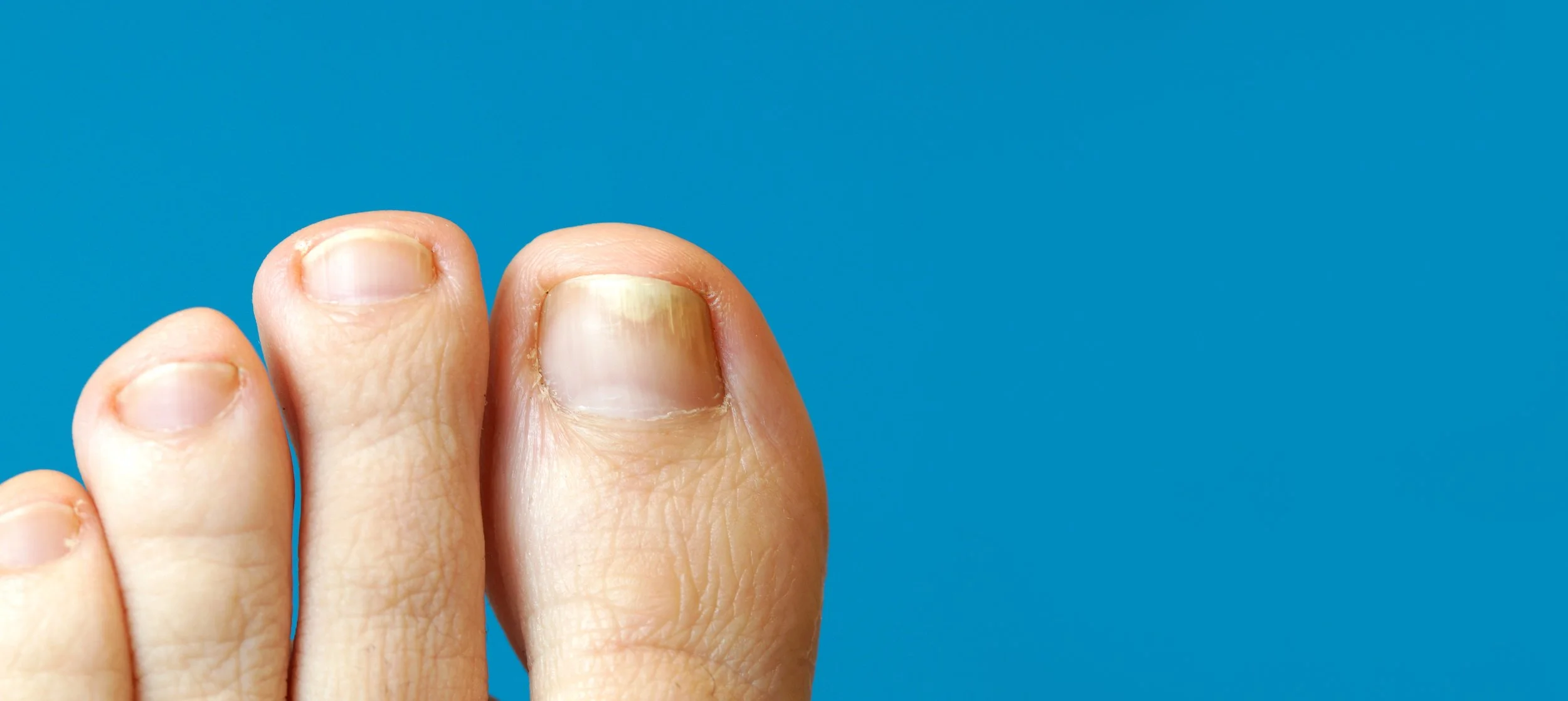 panoramic images of toe with nail psoriasis. A woman has an ingr