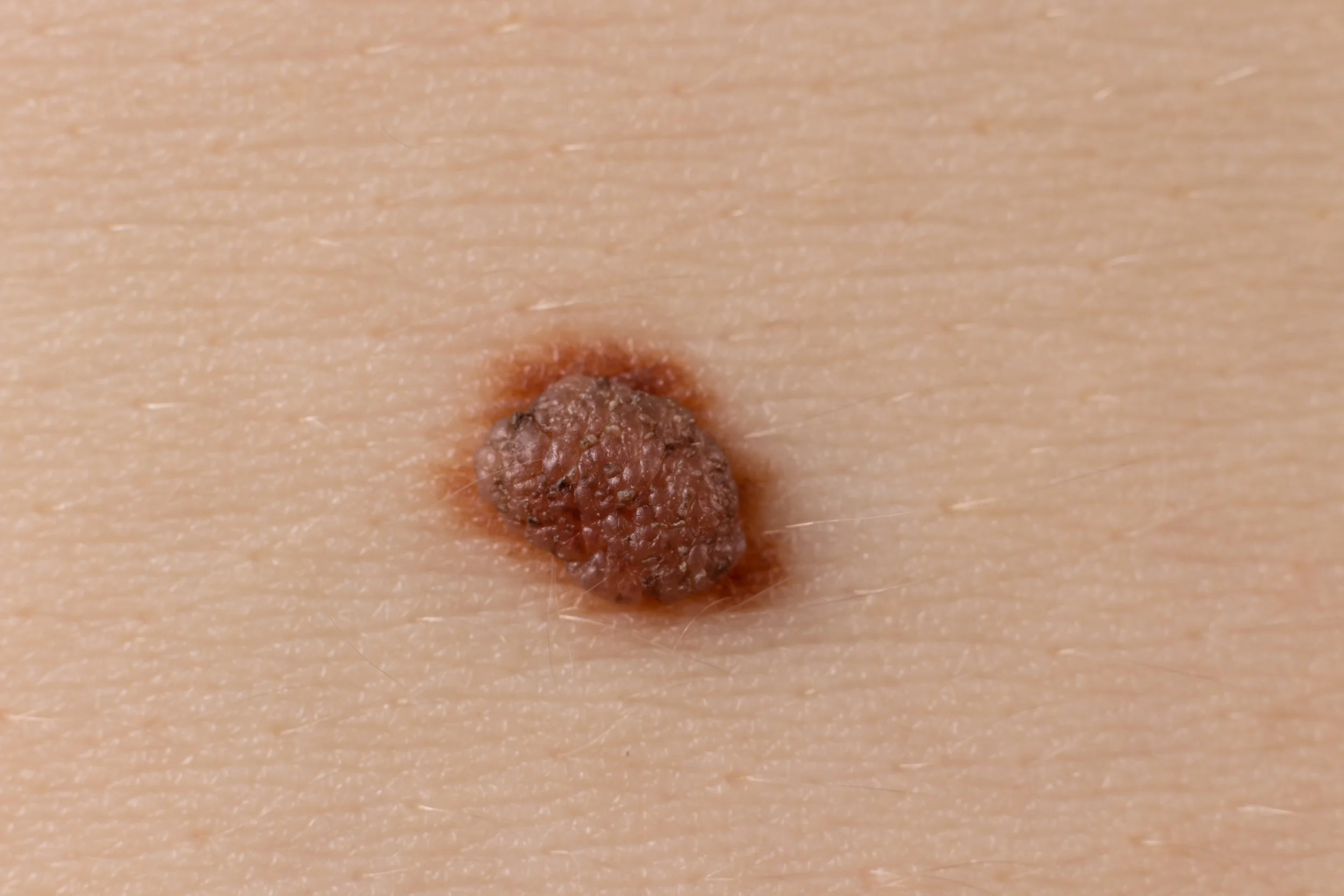 Square Mole Skin Cancer Moles