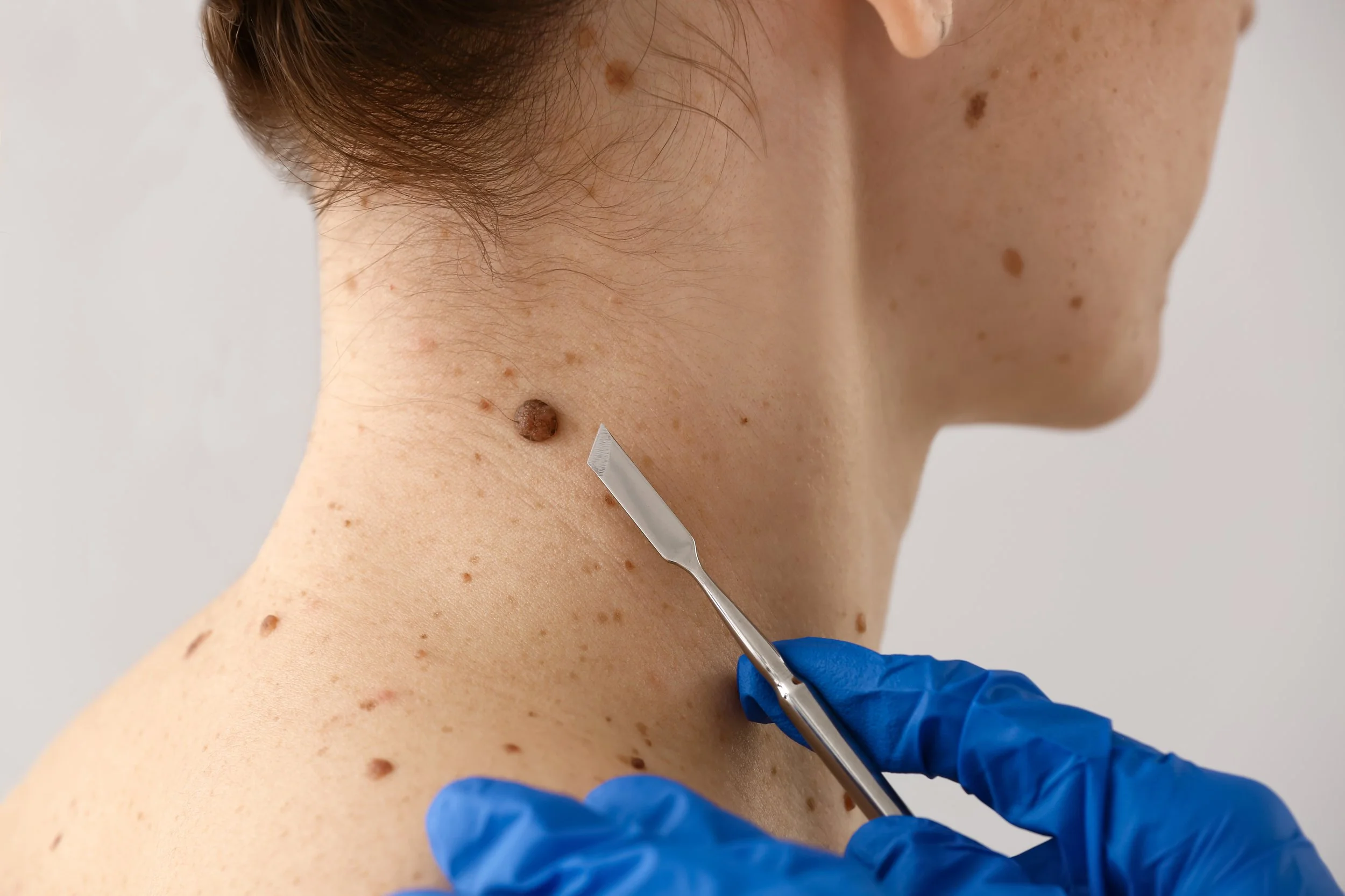 Dermatologist wearing gloves preparing to remove a raised mole on the neck with a surgical instrument