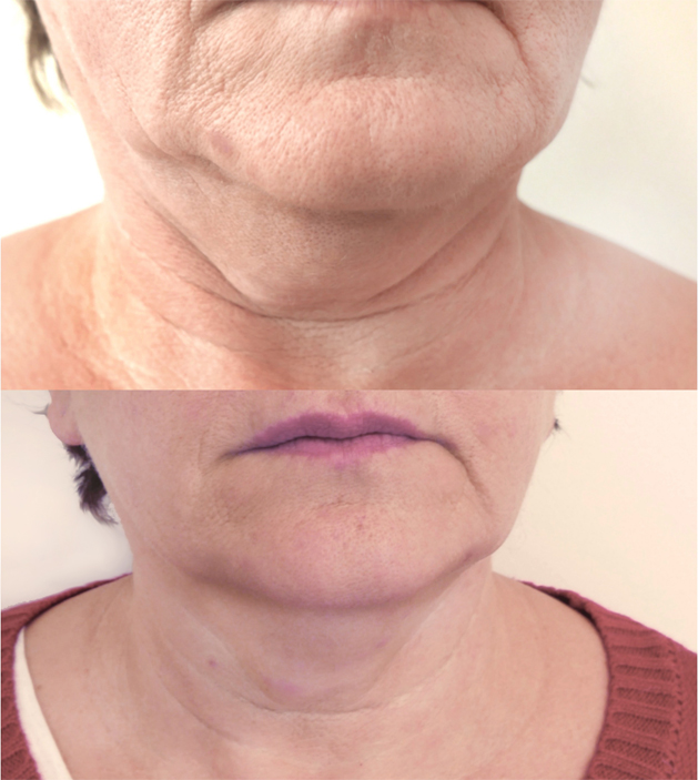Kybella B&A2.jpg