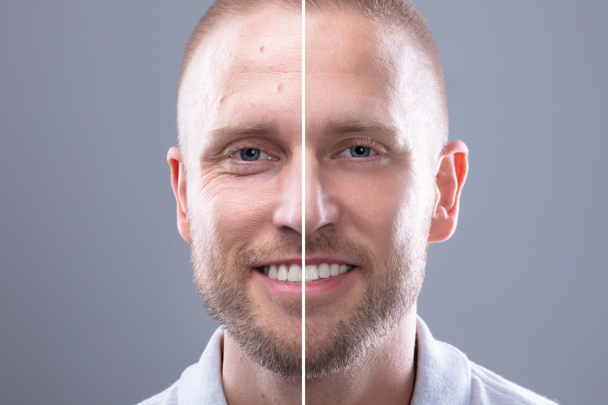 Microneedling for Facial Rejuvenation