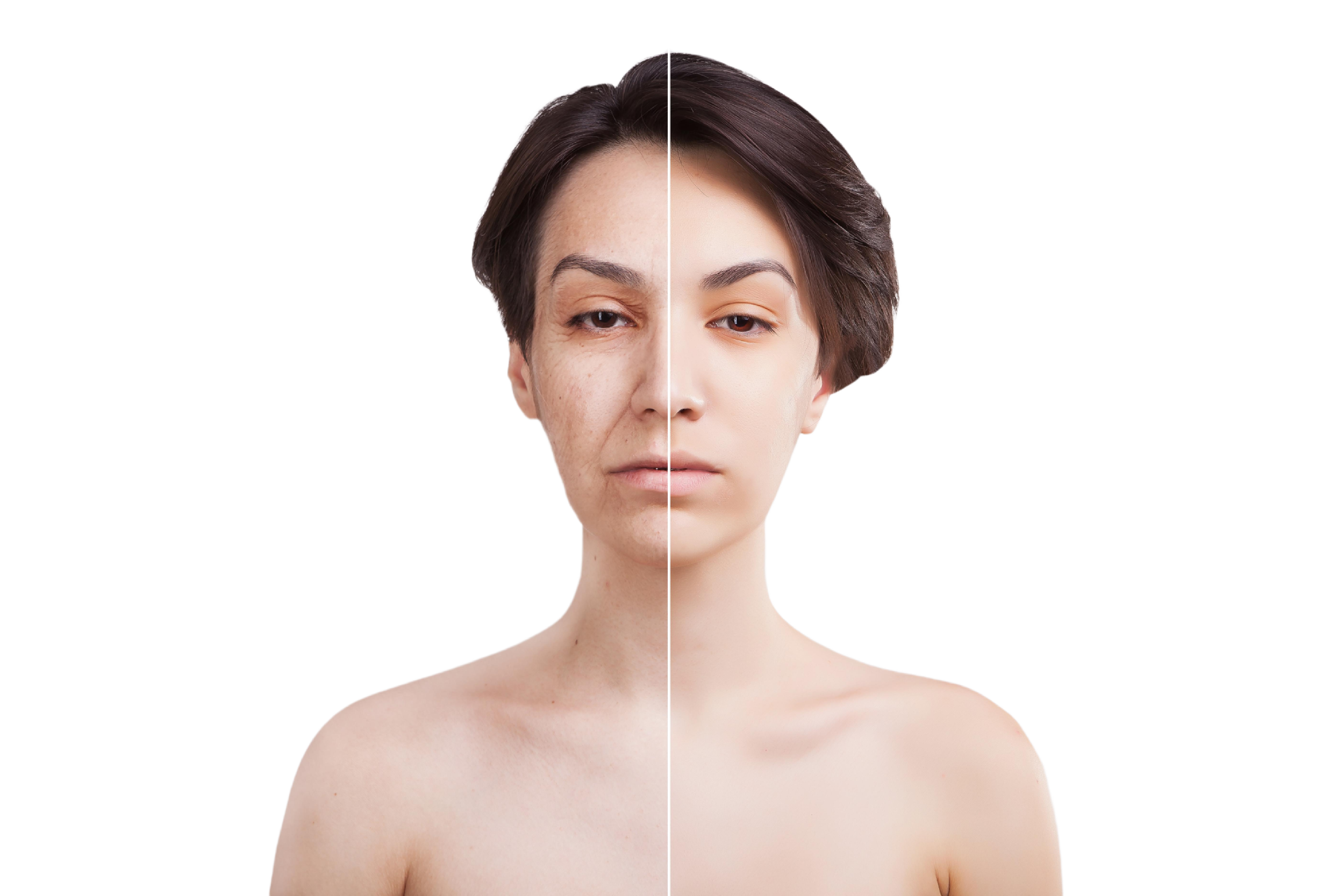 Microneedling for Facial Rejuvenation