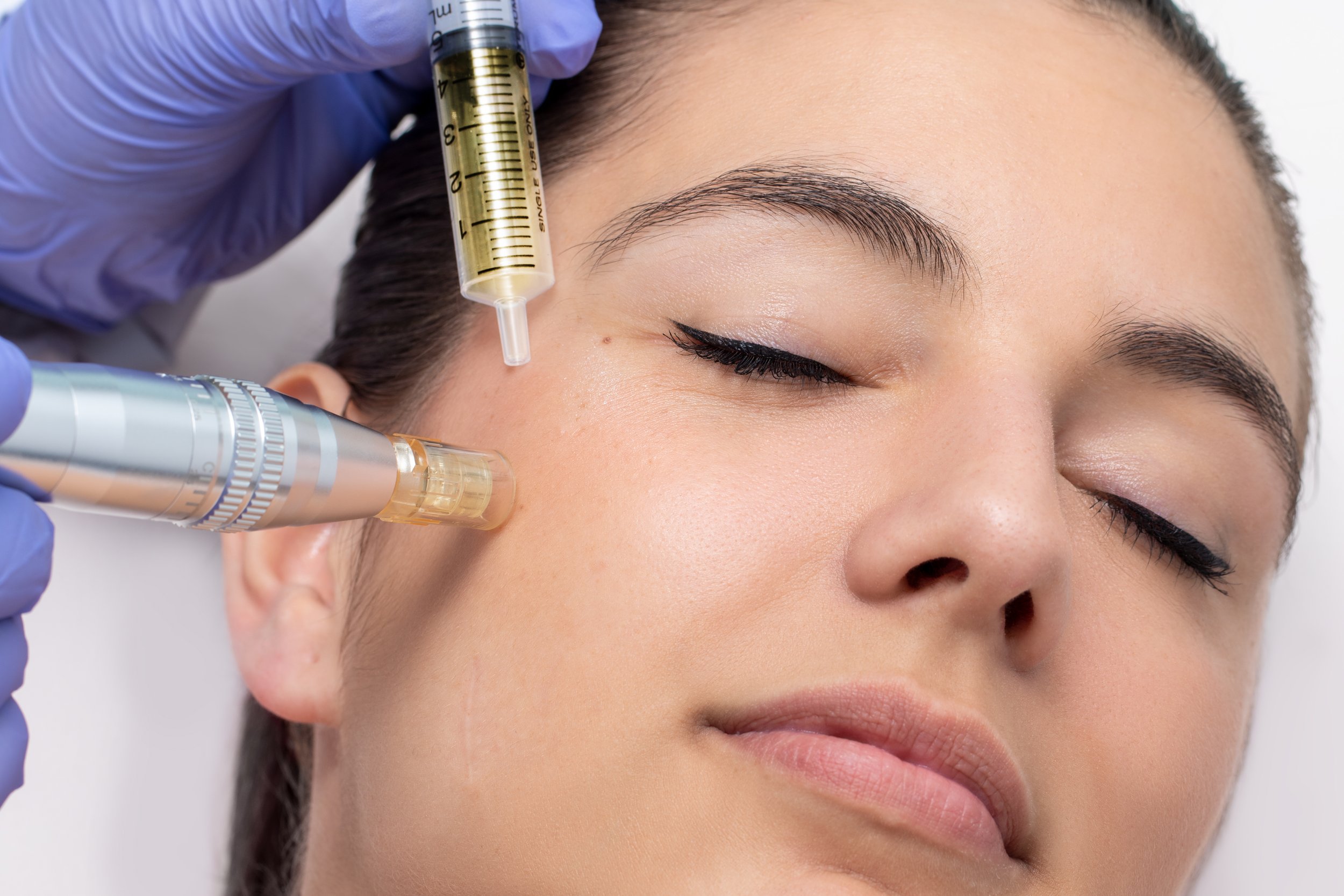 Holistic Skin Care - Microneedling for Facial Rejuvenation