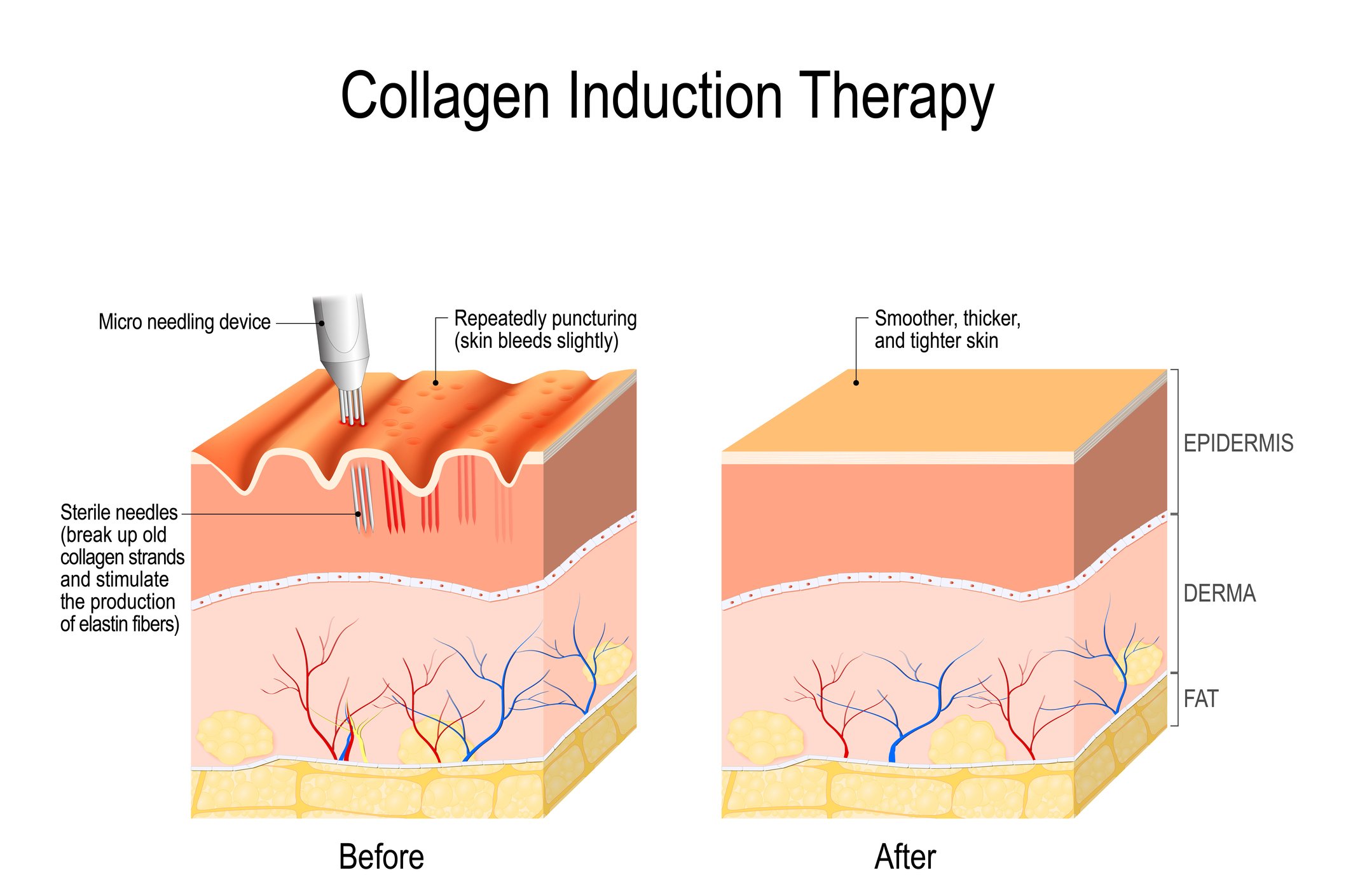 Collagen Induction Therapy Results