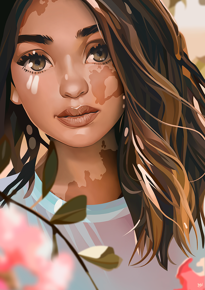 VITILIGO