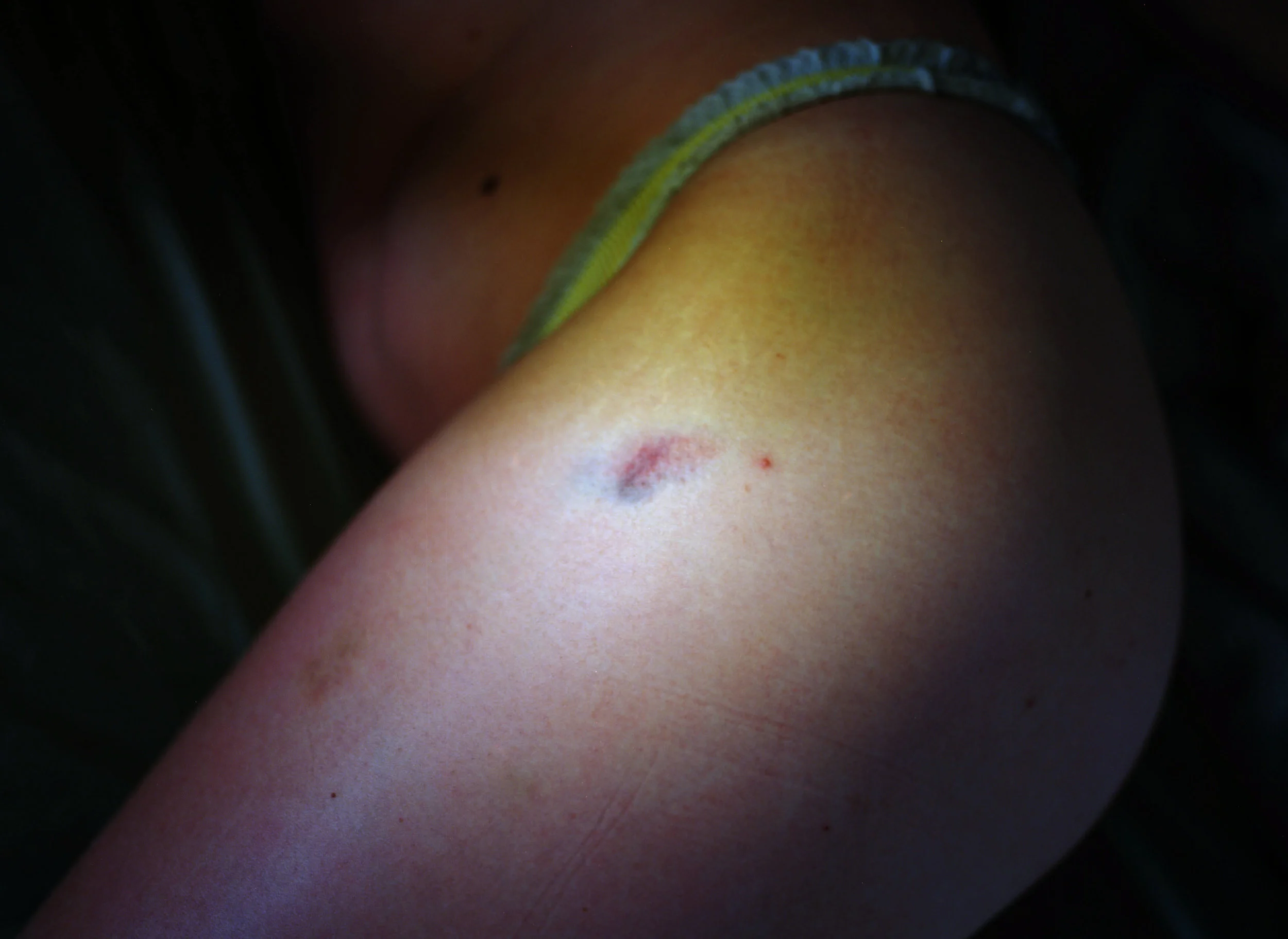 bruiseinside009.jpg