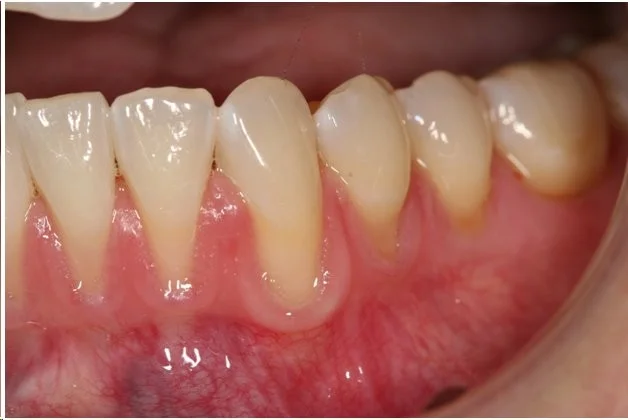 Dentist In Dallas TX All PPO Insurance Accepted Katy Trail Dental Common Causes Of 