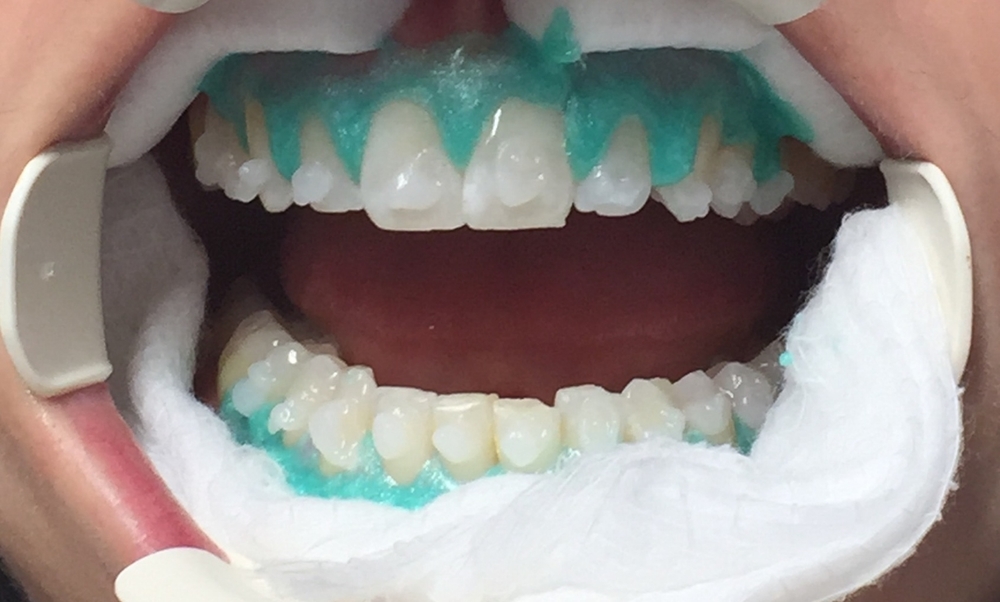 Teeth Whitening Lacey, WA - Tooth Bleaching Dentist
