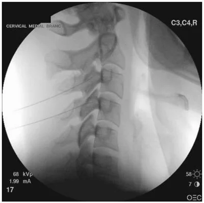 Cervical-Facet-Joint-Block-4.jpg