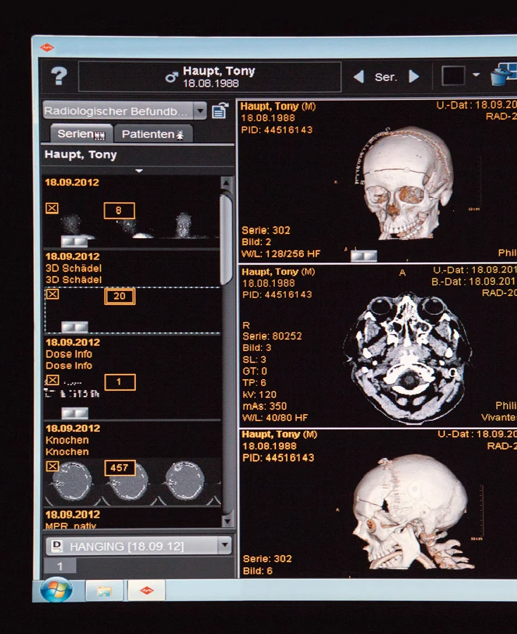 Computertomografien (3D-Scanning) wurden vom Schädel gefertigt. Diue auf den Scans erkennbaren Klammern hielten die Schädeldecke zusammen.