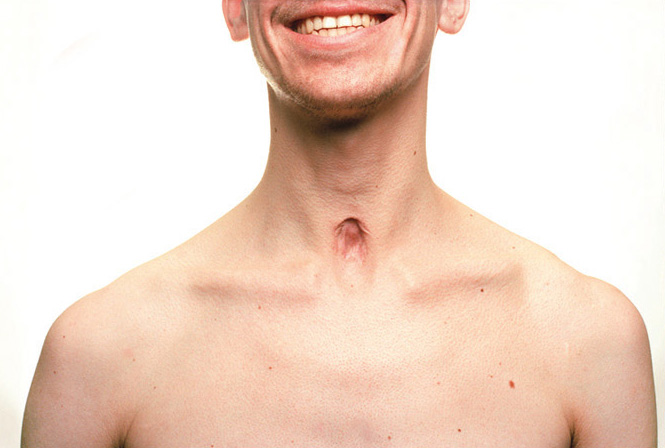   Selbstportraits nach 6 Monaten.   Bruch der linken Klavikula und Narbe durch Tracheal-Kanüle.   