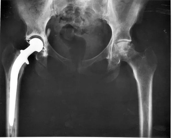 Hip- joint replacement.