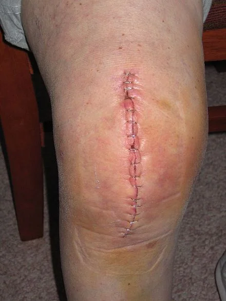 Incision from knee-replacement surgery