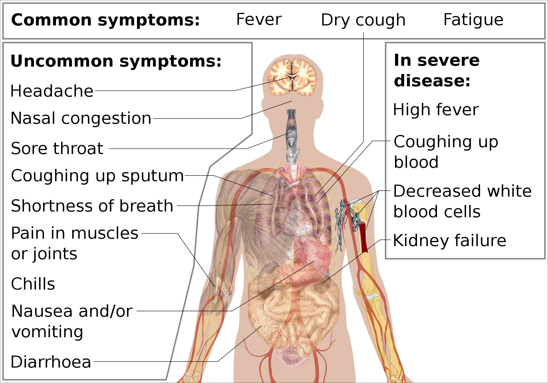 1920px-Symptoms_of_coronavirus_disease_2019_2.0.svg.png