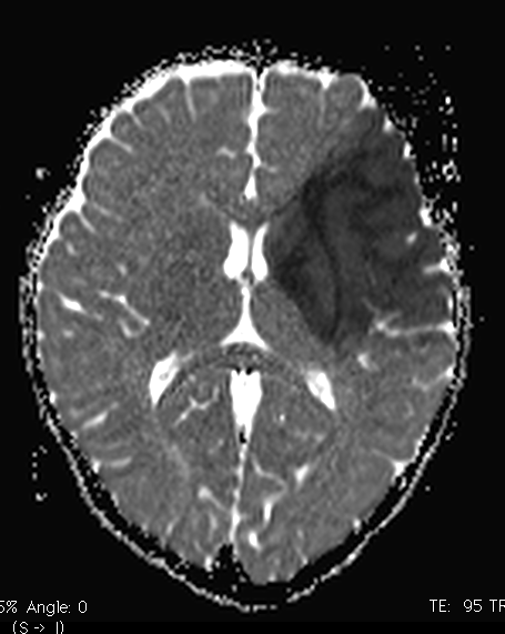  An MRI of Chase’s brain one day after his stroke on May 20, 2014. The dark matter is severely damaged brain tissue from the stroke.  