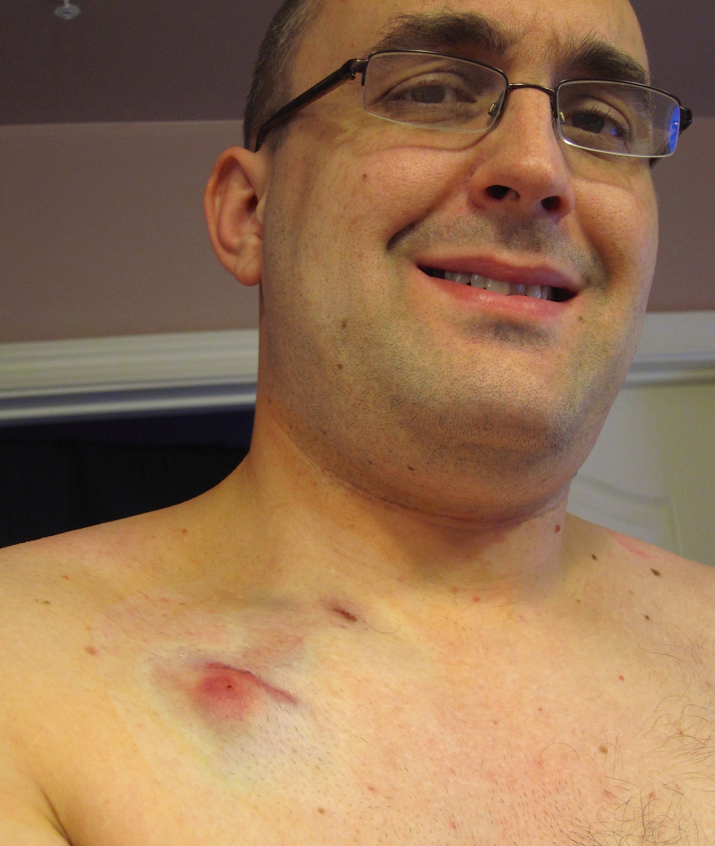 Because Mediports are so damned sexy! I got my Mediport placed just days before starting chemotherapy on March 14th, 2011.