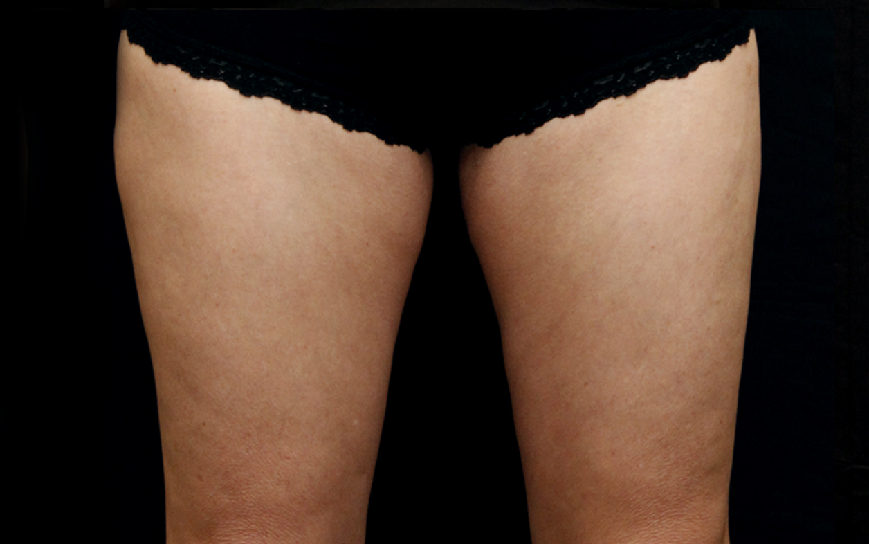 Women-Thighs