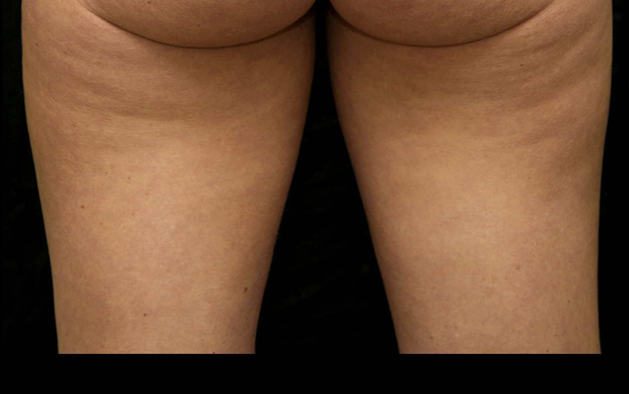 Women-Thighs