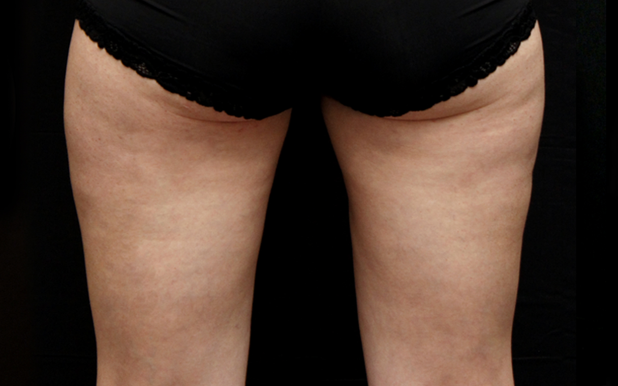 Women-Thighs