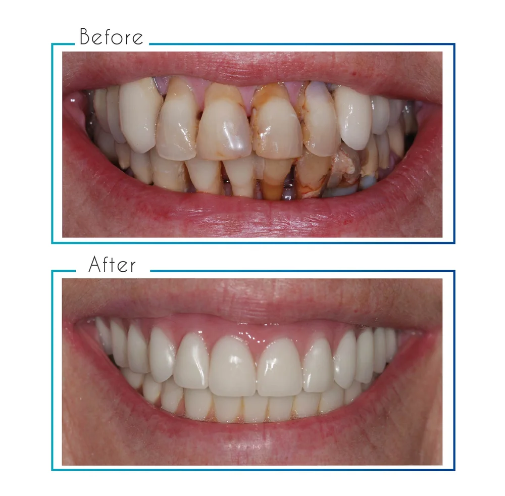 Prosthodontist and Cosmetic Dentist Long Island NY — Long Island