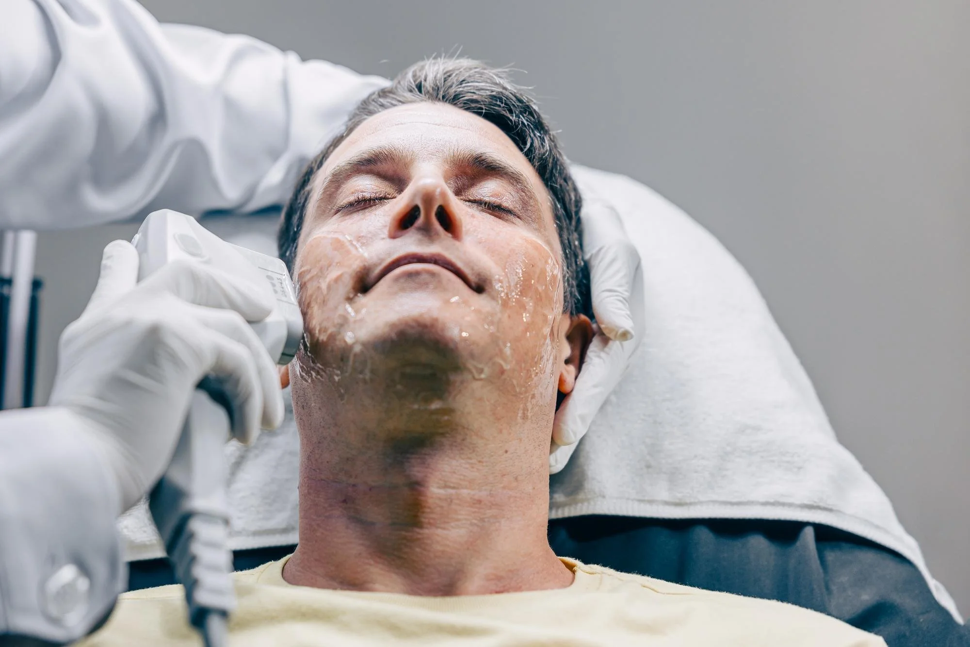 How Long Does a Chemical Peel Last? A Complete Guide for Men