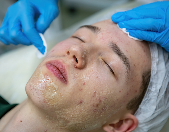 Aesthetician performing a chemical peel for acne scars to smooth uneven tone and reduce post-acne marks.