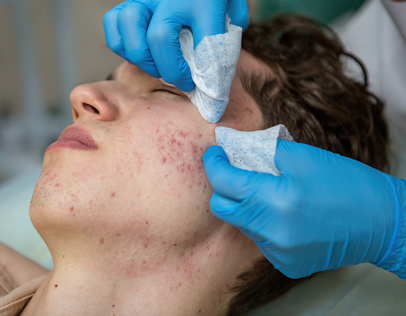 Man undergoing an advanced TCA peel for acne scars, targeting deeper scarring and discoloration.