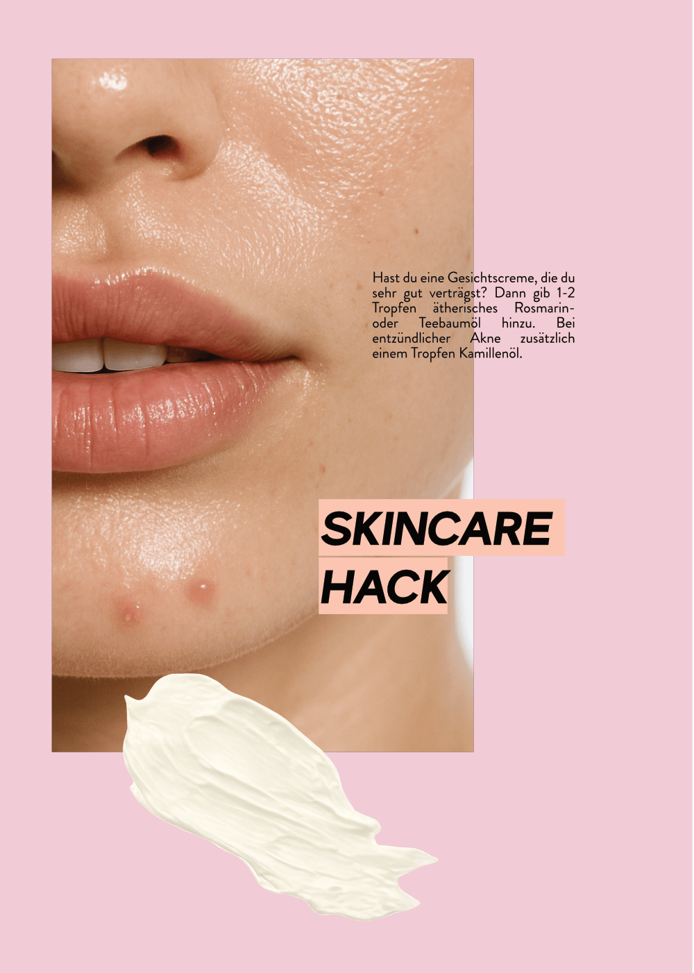 Akne natürlich behandeln.