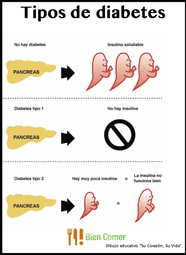 Tipos Diabetes.jpg