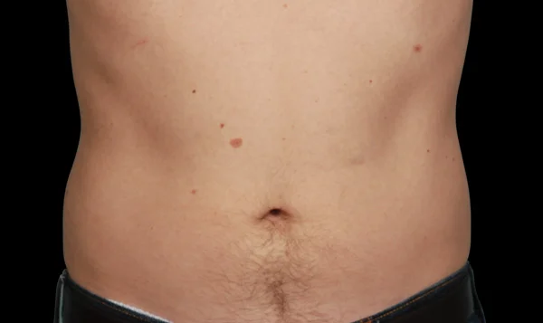 CoolSculpting for Men's Abdomen, After