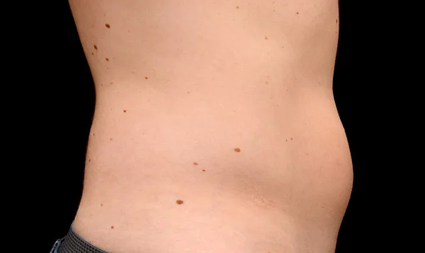 Coolsculpting Results for Men's Abdomen, Before