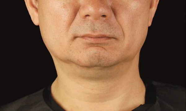 CoolSculpting Results for Men's chin, After