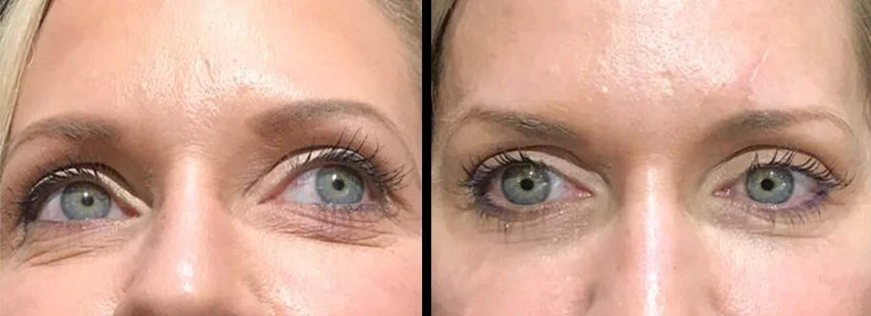 PDO Thread Lift - Anew You Medical Aesthetics and Total Wellness Clinic