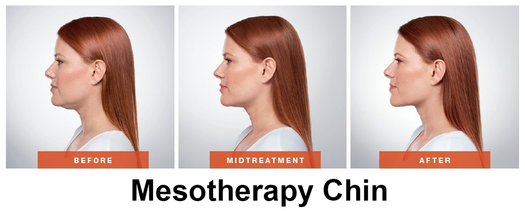 mesotherapy chin anew you.JPG
