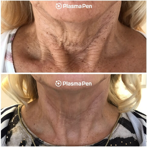 Plasma-Pen-Treatment-Before-and-After-Neck-Lift-Full-Size-02.jpg