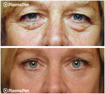 6-Plasma-Pen-Treatment-Before-And-After-Upper-And-Lower-Eyelids-Blepharoplasty.jpg