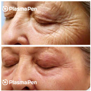 Plasma-Pen-Treatment-Before-And-After-Upper-Eyelids-Blepharoplasty-Full-Size-03-300x300.jpg