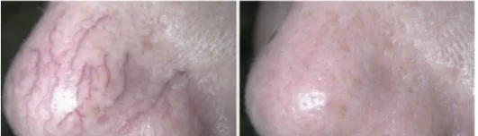 Before and after a single Vasculaze session showing vessels cleared from the side of the nose
