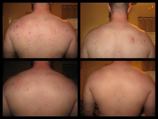 Series of 4 treatments over 2 months.