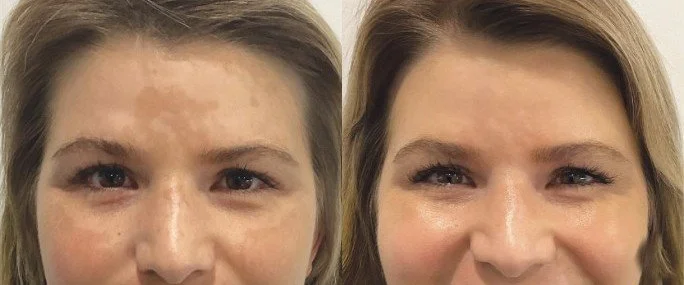 1927 nm laser before and after with faded brown patches on the forehead and a more even facial tone, San Diego
