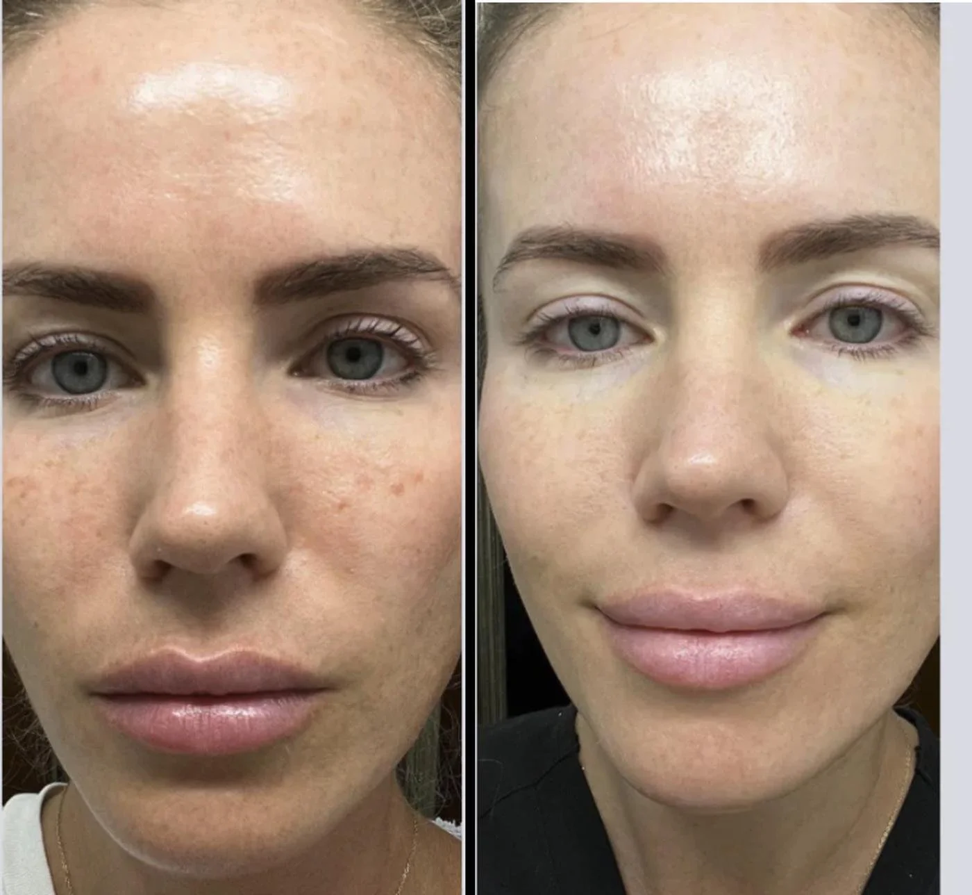 Before and after of a woman's skin showing clearer, more even tone after a PRX biorevitalization series