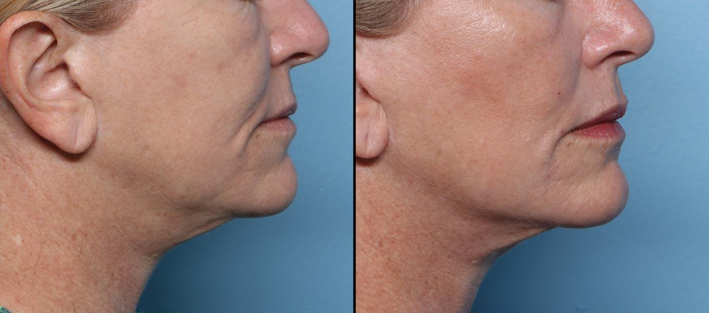 Before and after of a woman's jawline and neck, four weeks after one XERF skin tightening treatment