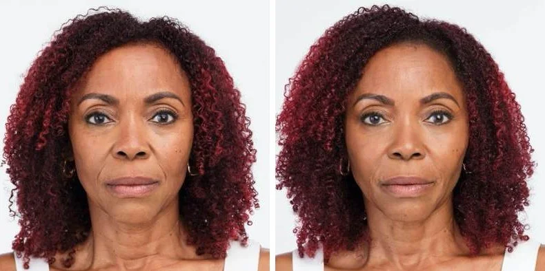 Radiesse before and after example, front view showing softened marionette lines and firmer lower face, Radiesse San Diego