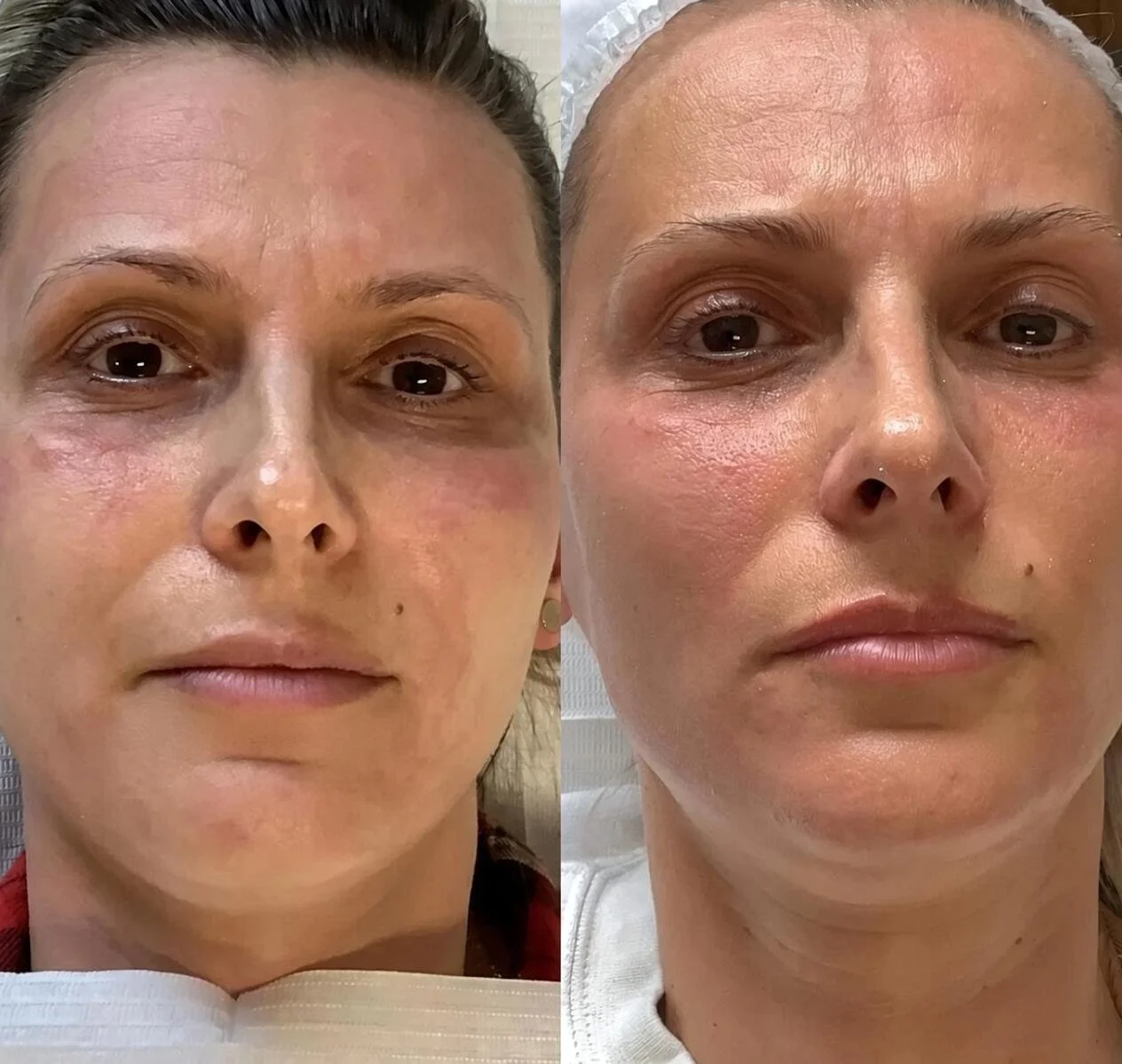 Before and after PRP microneedling showing a woman's skin looking plumper and more even, treated by the Satori medical team